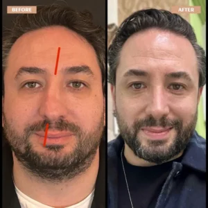 Primary Rhinoplasty Before & After