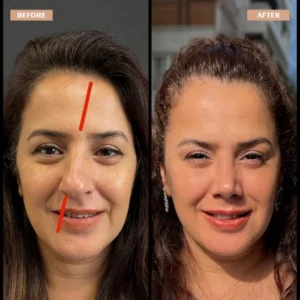Primary Rhinoplasty Before & After