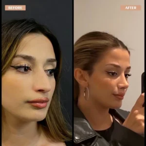 Primary Rhinoplasty Before & After