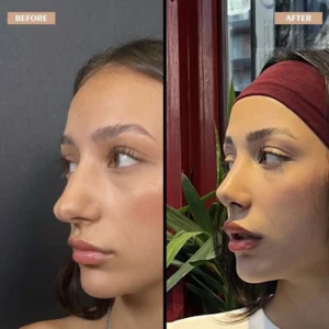 Primary Rhinoplasty Before & After