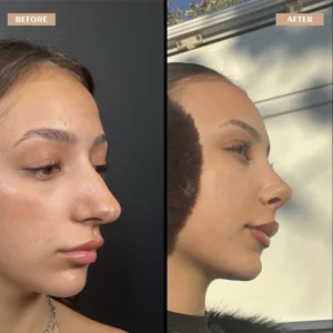 Primary Rhinoplasty Before & After