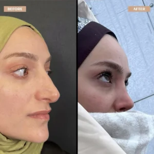 Primary Rhinoplasty Before & After