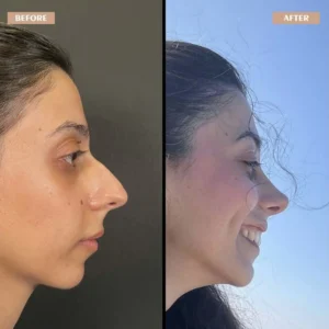 Primary Rhinoplasty Before & After