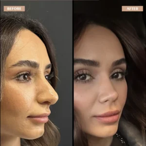 Primary Rhinoplasty Before & After