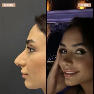 Primary Rhinoplasty Before & After