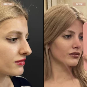Primary Rhinoplasty Before & After