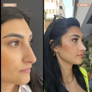 Primary Rhinoplasty Before & After