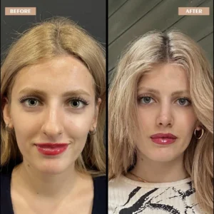 Primary Rhinoplasty Before & After