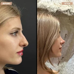Primary Rhinoplasty Before & After