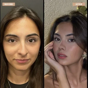 Primary Rhinoplasty Before & After