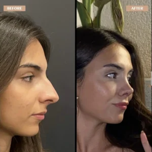 Primary Rhinoplasty Before & After