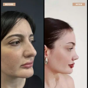 Primary Rhinoplasty Before & After