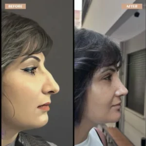Primary Rhinoplasty Before & After