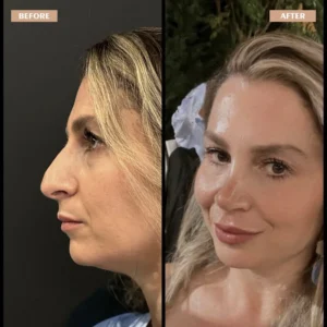 Primary Rhinoplasty Before & After