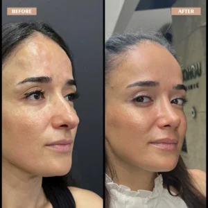 Primary Rhinoplasty Before & After