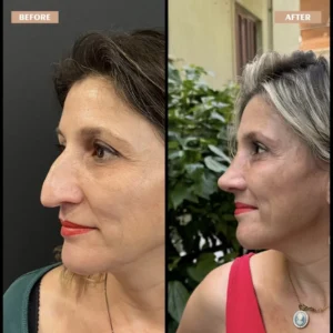 Primary Rhinoplasty Before & After