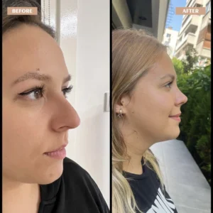 Primary Rhinoplasty Before & After