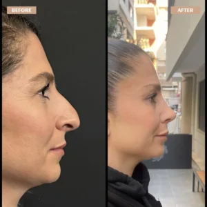 Primary Rhinoplasty Before & After