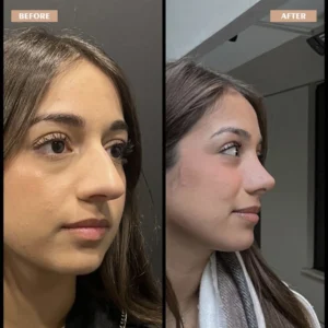 Primary Rhinoplasty Before & After