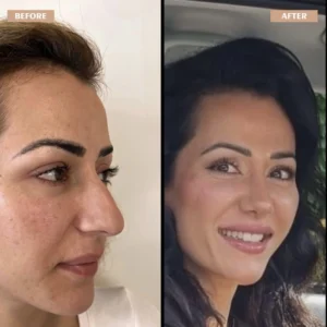 Primary Rhinoplasty Before & After