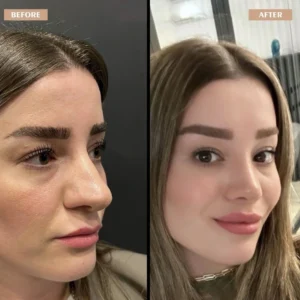 Primary Rhinoplasty Before & After