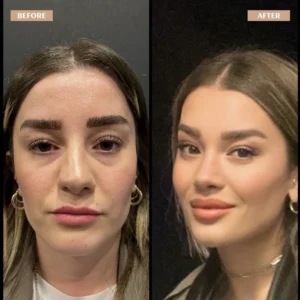 Primary Rhinoplasty Before & After