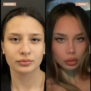 Primary Rhinoplasty Before & After