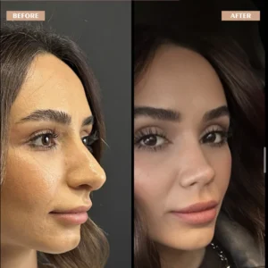 Primary Rhinoplasty Before & After