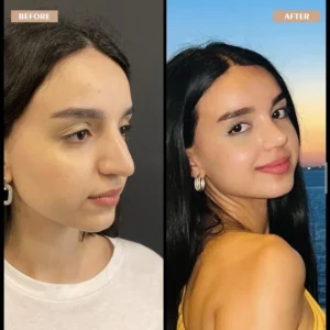 Primary Rhinoplasty Before & After