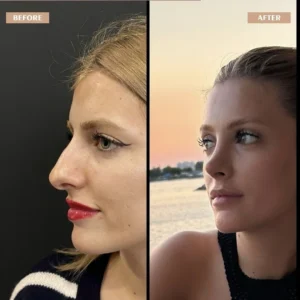 Primary Rhinoplasty Before & After