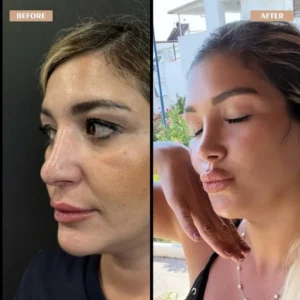 Primary Rhinoplasty Before & After