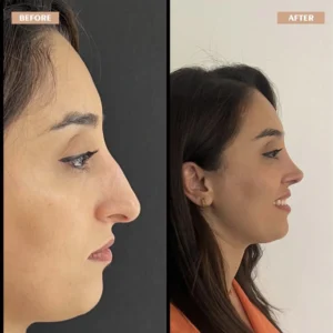 Primary Rhinoplasty Before & After