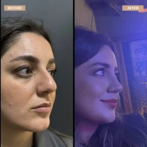 Primary Rhinoplasty Before & After