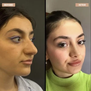 Primary Rhinoplasty Before & After