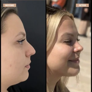 Primary Rhinoplasty Before & After