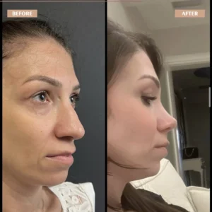 Primary Rhinoplasty Before & After