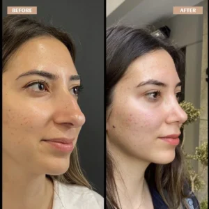Primary Rhinoplasty Before & After