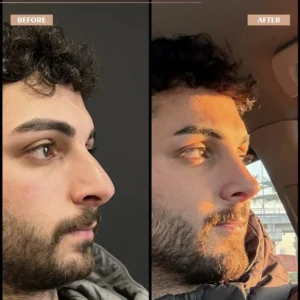 Primary Rhinoplasty Before & After