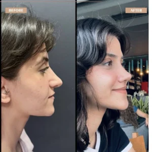 Primary Rhinoplasty Before & After