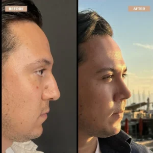 Primary Rhinoplasty Before & After