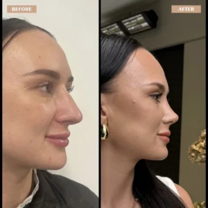 Primary Rhinoplasty Before & After