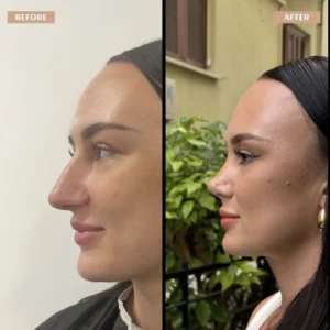 Primary Rhinoplasty Before & After