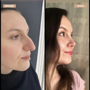 Primary Rhinoplasty Before & After