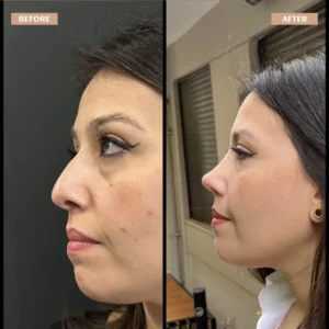 Primary Rhinoplasty Before & After