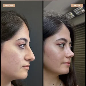 Primary Rhinoplasty Before & After