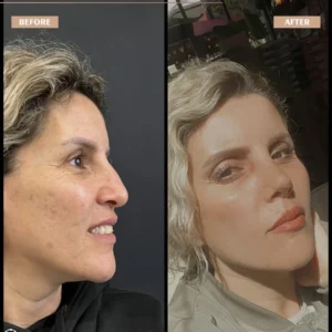 Primary Rhinoplasty Before & After