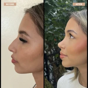 Primary Rhinoplasty Before & After