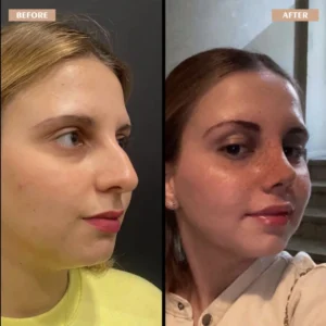 Primary Rhinoplasty Before & After