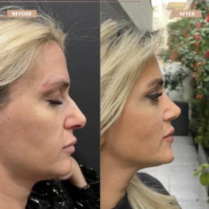 Primary Rhinoplasty Before & After