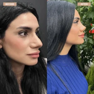 Primary Rhinoplasty Before & After